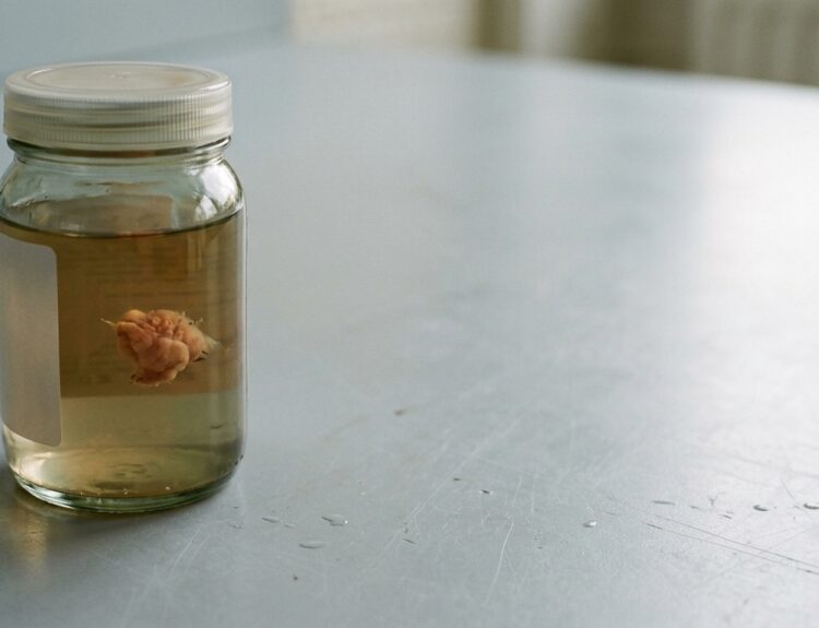 The EPoS II Trial Just Made the 3-Year Colonoscopy Standard Look Like a Reflex, Not a Rule